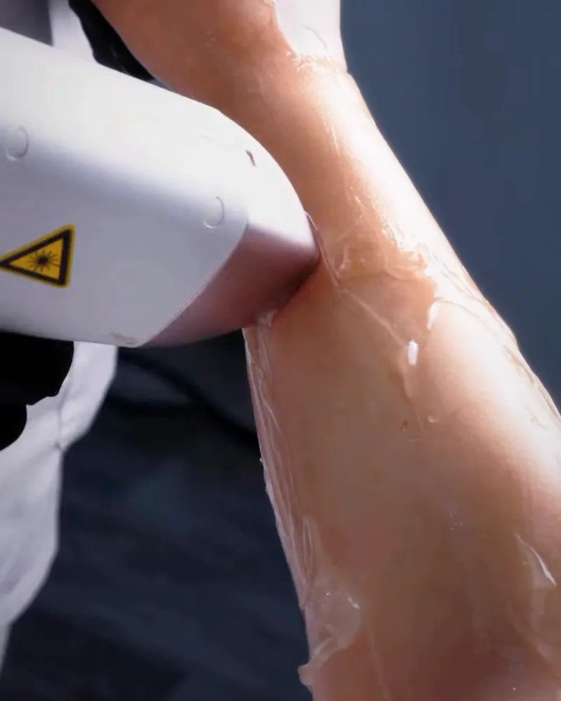 Séance d'épilation laser sur le bras, chez Dermoskin